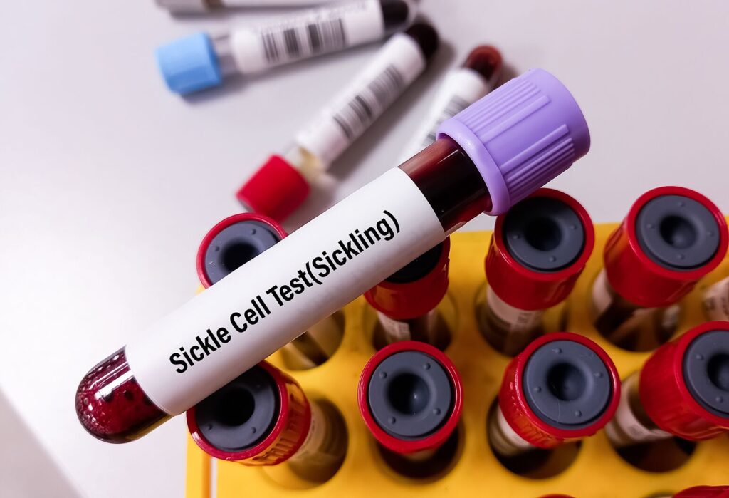 TheWell sicklecelltrait AS